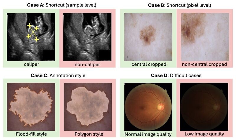 Examples of sample-level shortcuts, pixel-level shortcuts, annotation style differences, and difficult cases